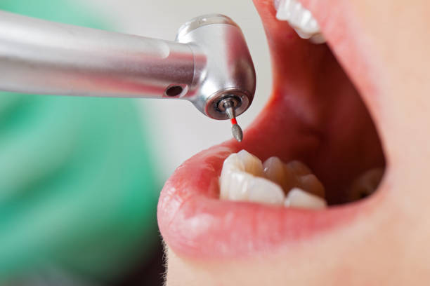 Best Broken or Cracked Tooth Emergency Dentist in Keene, NH